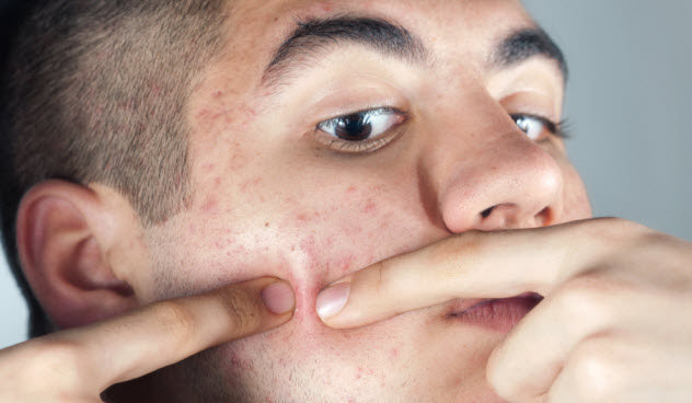 10-acne_000016977363_Small