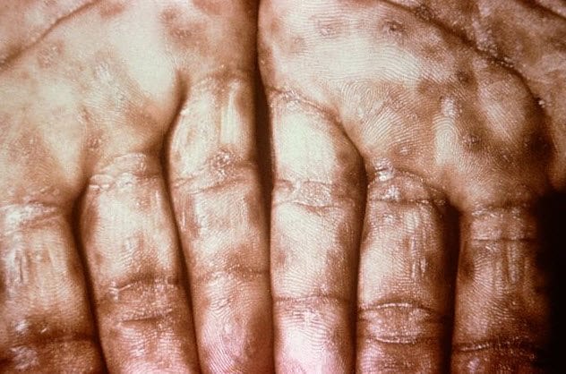 6-secondary-syphilitic-infection